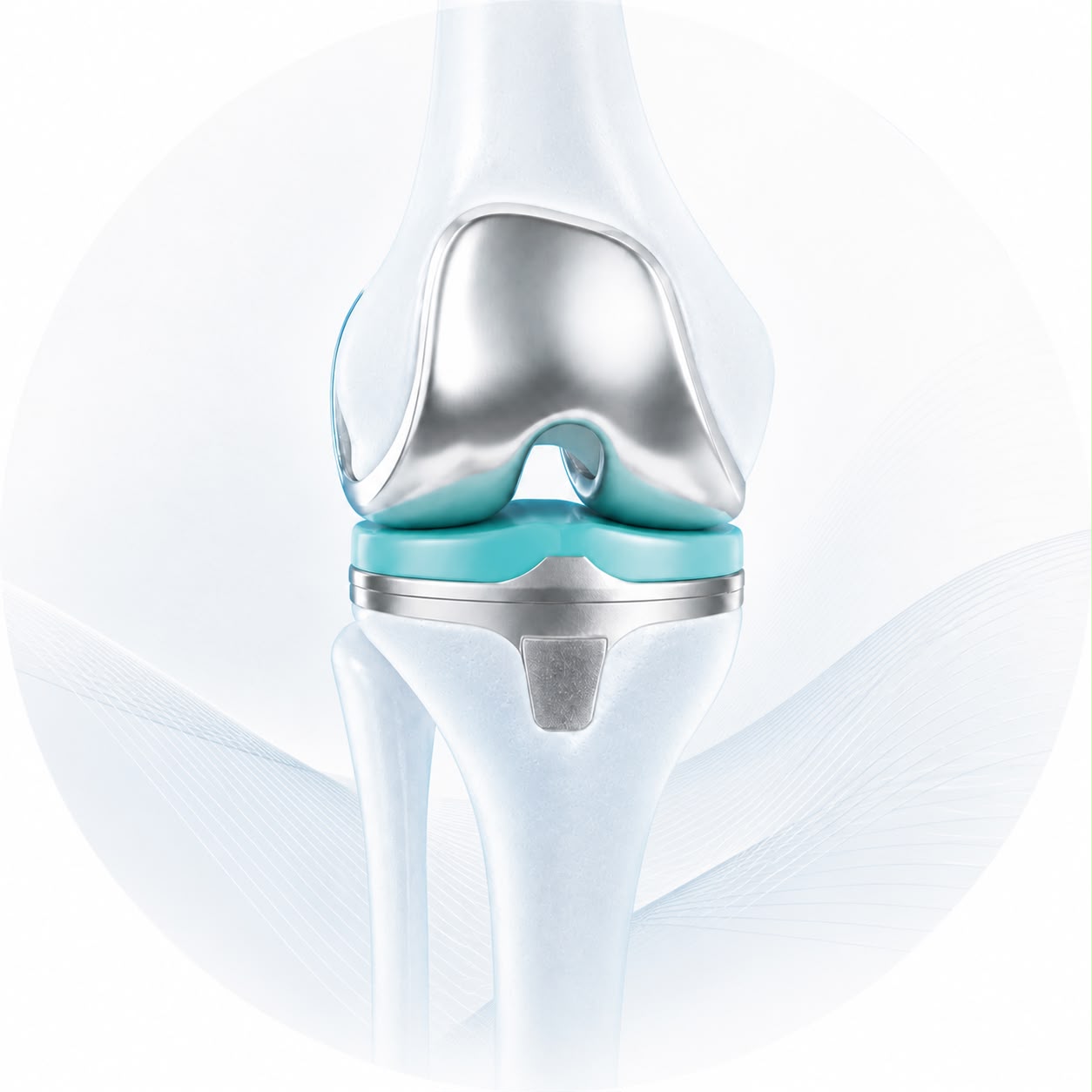 Ilustración de una prótesis de rodilla